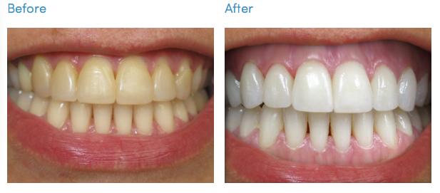 BeforeAfterTeethWhiteningLosAngeles-(2)