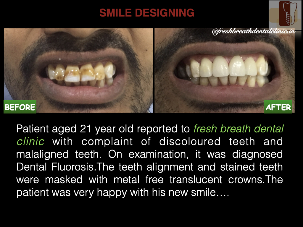 This Study Will Perfect Your tooth bleaching in Dwarka: Read Or Miss Out